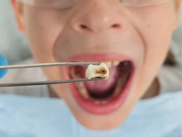 Best Emergency Dental Care for Broken or Chipped Teeth in Fletcher, NC